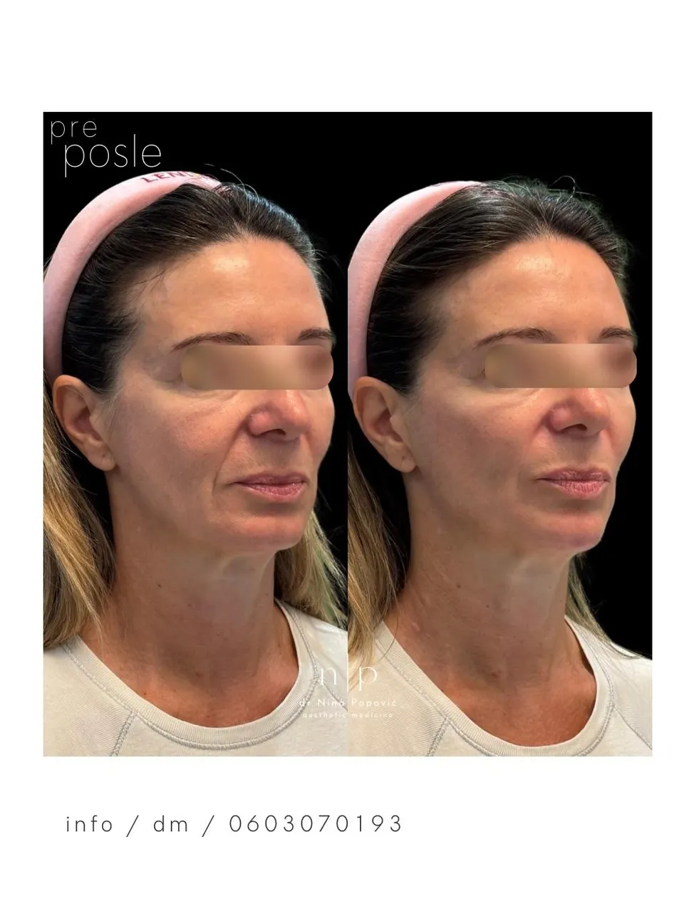 Hijaluronski fileri - full face