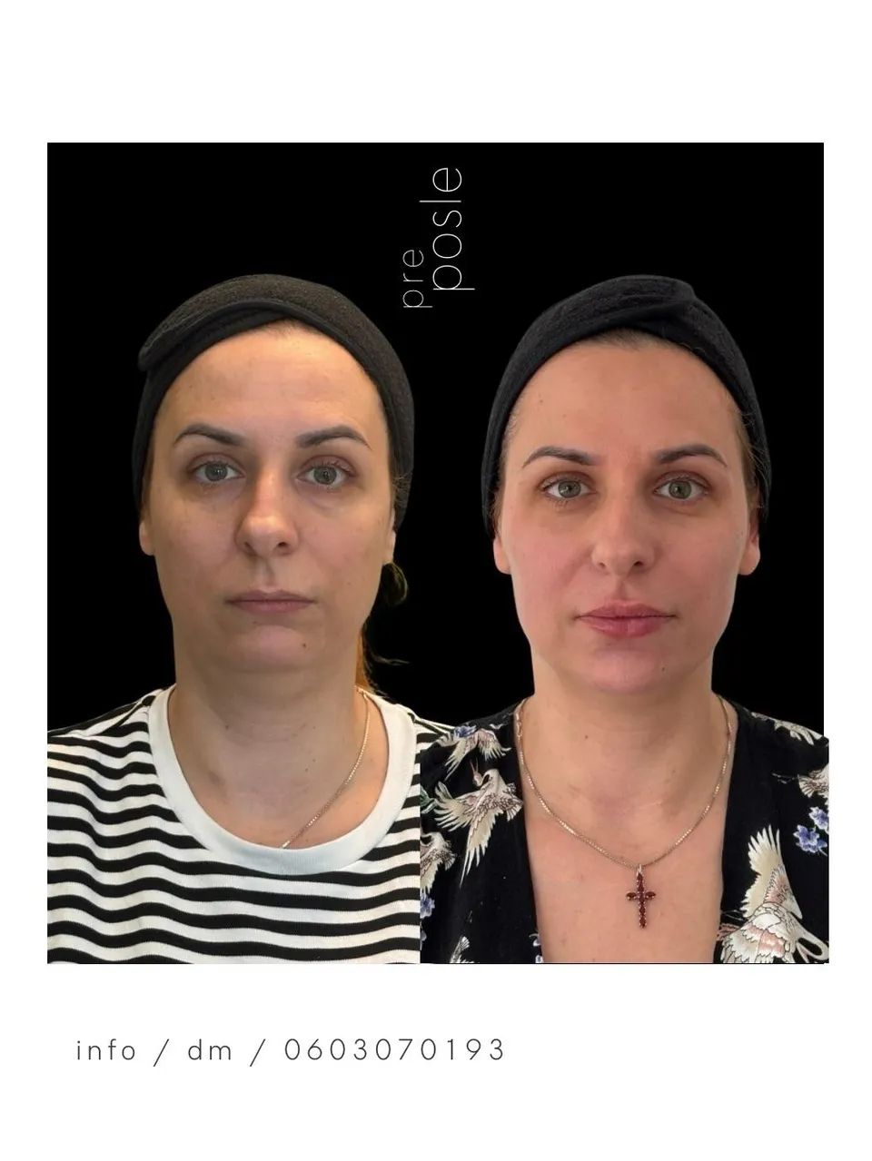 Harmonizacija celog lica